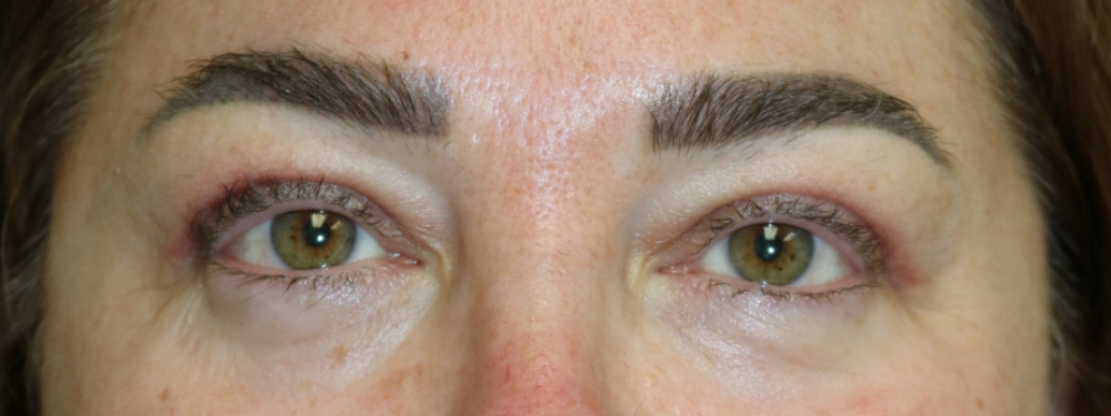 Upper Blepharoplasty Before & After