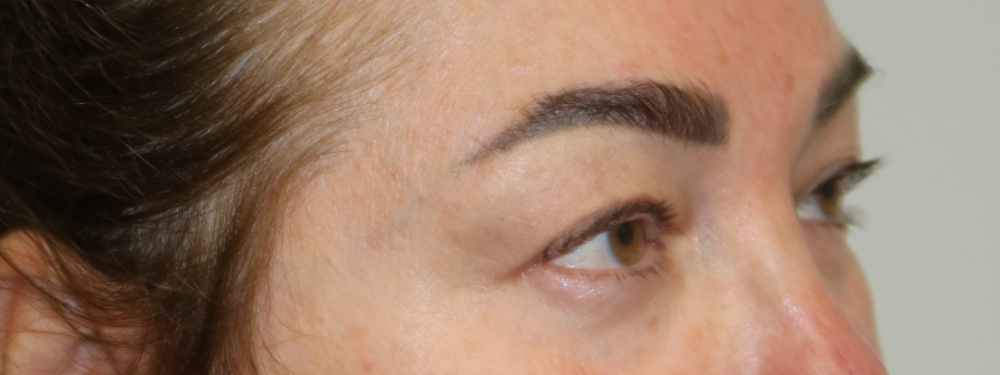 Upper Blepharoplasty Before & After