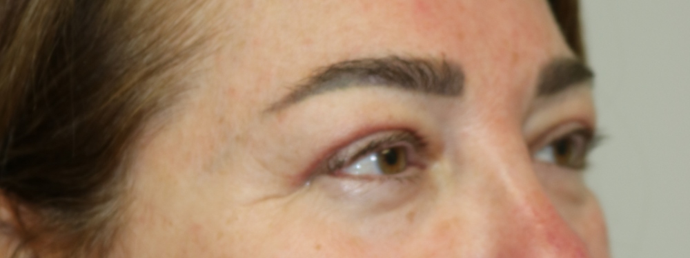 Upper Blepharoplasty Before & After