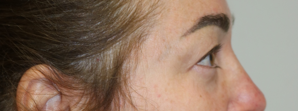 Upper Blepharoplasty Before & After