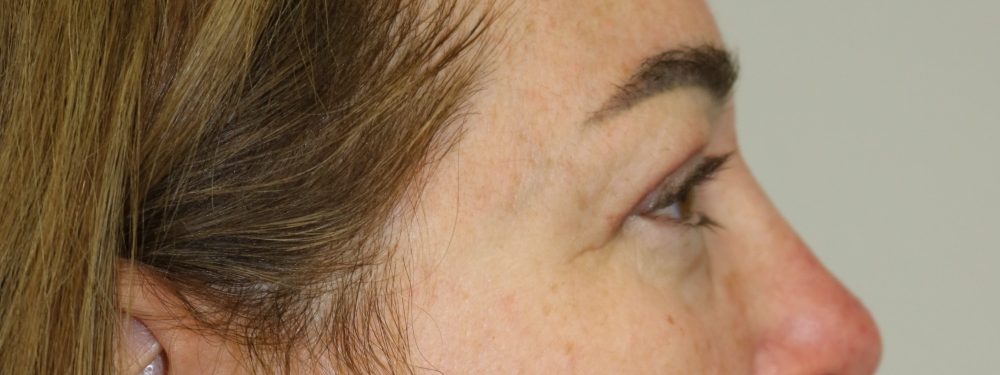 Upper Blepharoplasty Before & After