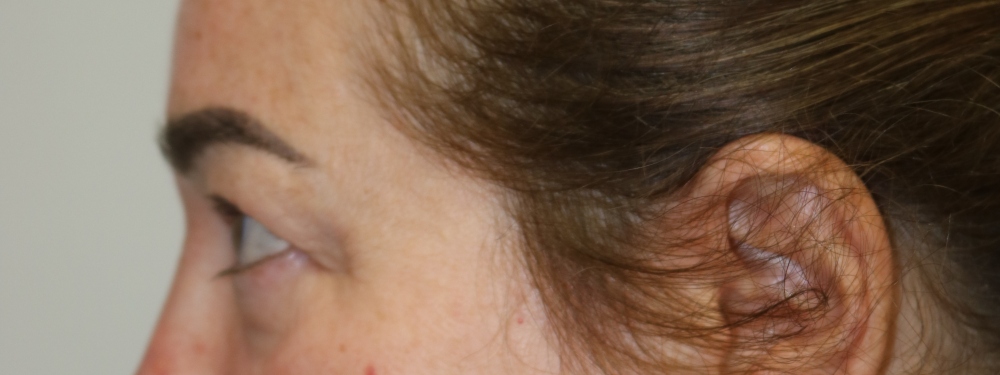 Upper Blepharoplasty Before & After