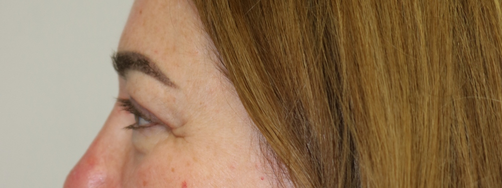 Upper Blepharoplasty Before & After