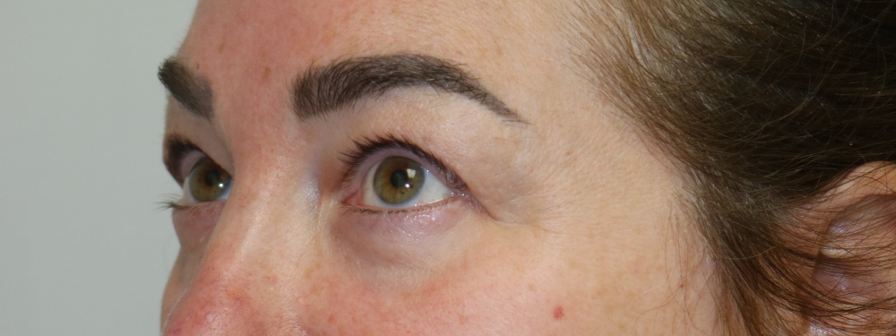 Upper Blepharoplasty Before & After