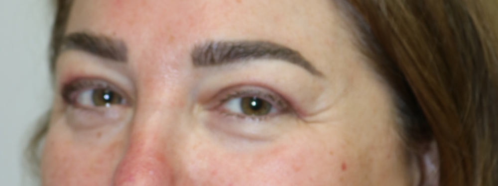 Upper Blepharoplasty Before & After