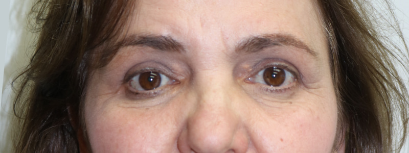 Upper Blepharoplasty Before & After