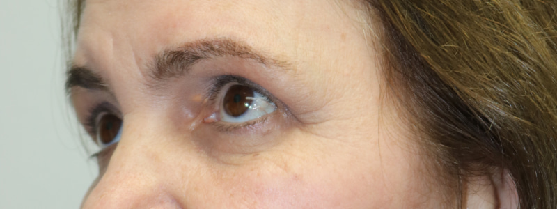 Upper Blepharoplasty Before & After