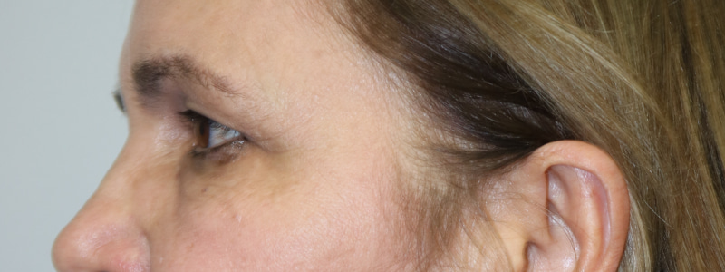 Upper Blepharoplasty Before & After