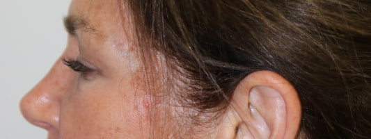 Upper Blepharoplasty Before & After