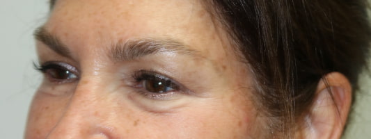 Upper Blepharoplasty Before & After