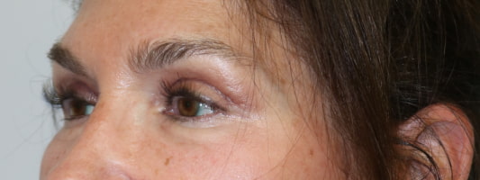 Upper Blepharoplasty Before & After