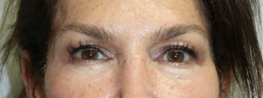 Upper Blepharoplasty Before & After