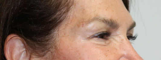 Upper Blepharoplasty Before & After
