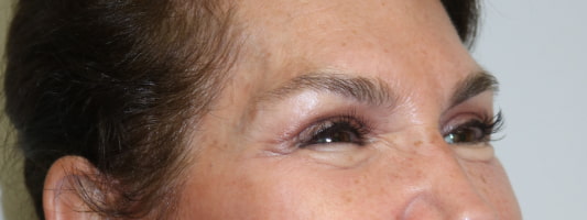 Upper Blepharoplasty Before & After