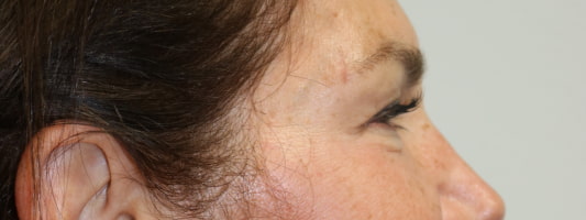 Upper Blepharoplasty Before & After
