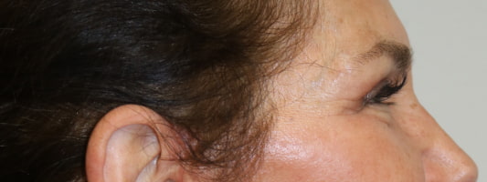 Upper Blepharoplasty Before & After