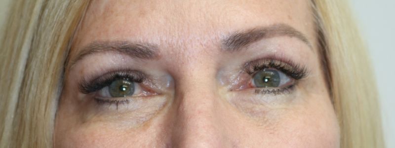 Upper Blepharoplasty Before & After