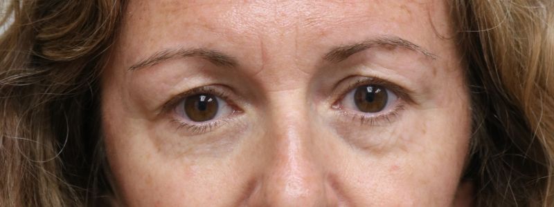 Upper Blepharoplasty Before & After