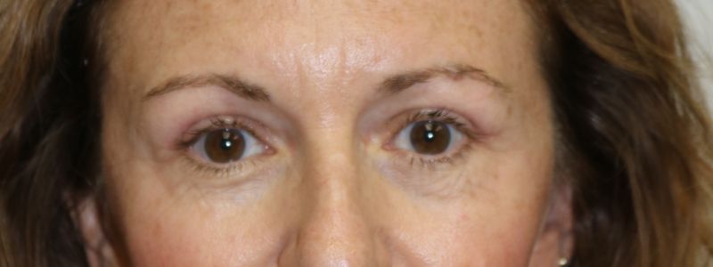 Upper Blepharoplasty Before & After