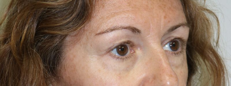 Upper Blepharoplasty Before & After