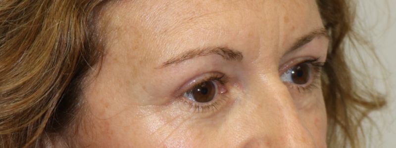 Upper Blepharoplasty Before & After