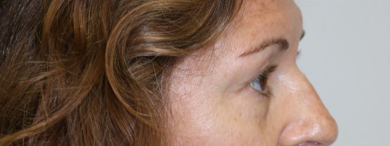Upper Blepharoplasty Before & After