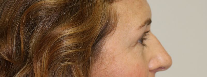 Upper Blepharoplasty Before & After