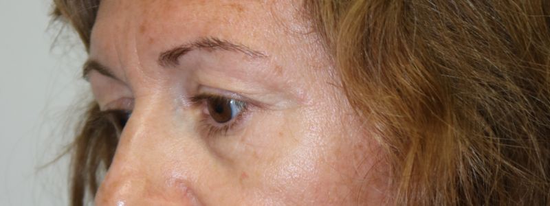 Upper Blepharoplasty Before & After