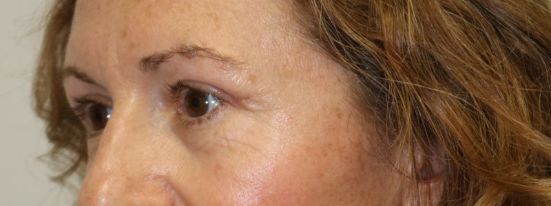 Upper Blepharoplasty Before & After
