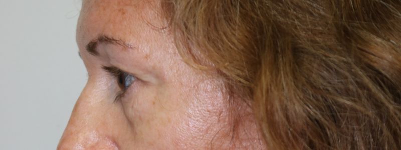 Upper Blepharoplasty Before & After