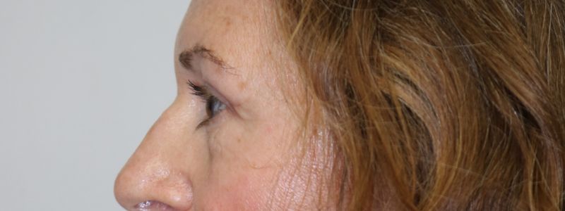 Upper Blepharoplasty Before & After