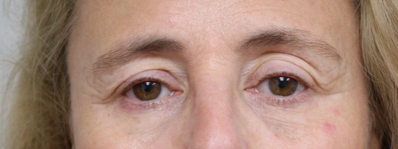 Upper Blepharoplasty Before & After