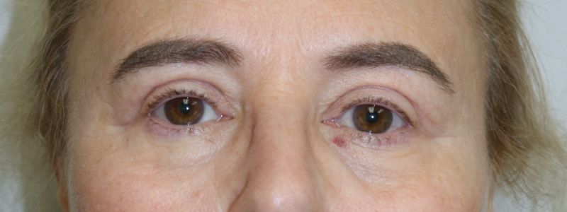 Upper Blepharoplasty Before & After