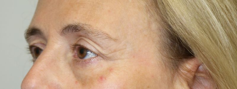 Upper Blepharoplasty Before & After