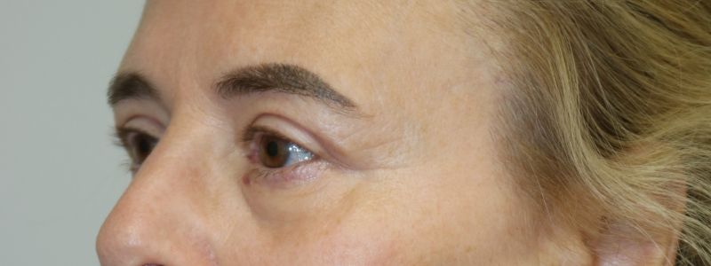 Upper Blepharoplasty Before & After