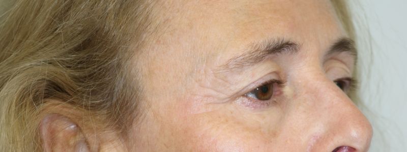 Upper Blepharoplasty Before & After