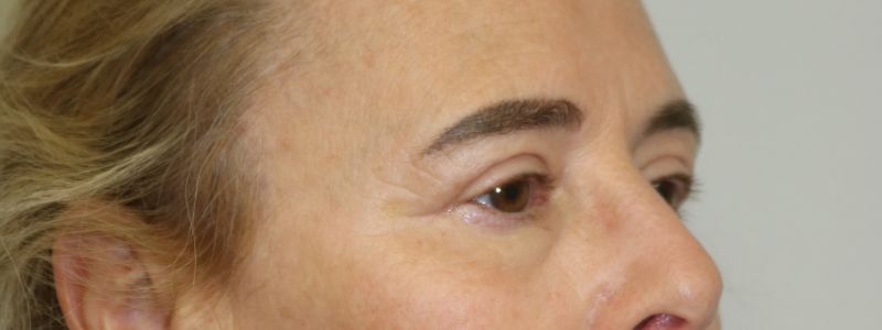 Upper Blepharoplasty Before & After