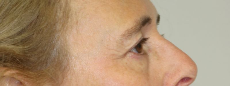 Upper Blepharoplasty Before & After