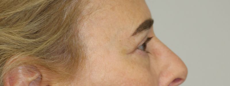 Upper Blepharoplasty Before & After
