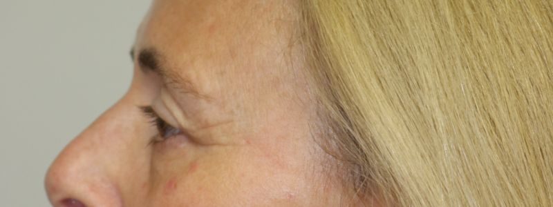 Upper Blepharoplasty Before & After