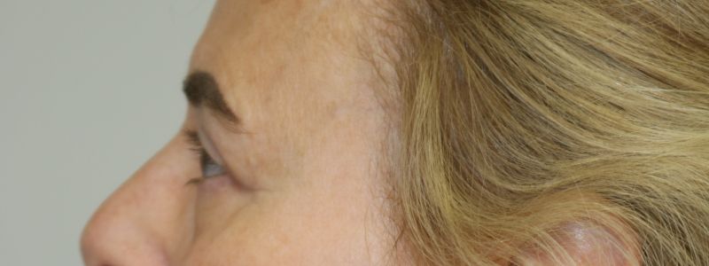 Upper Blepharoplasty Before & After