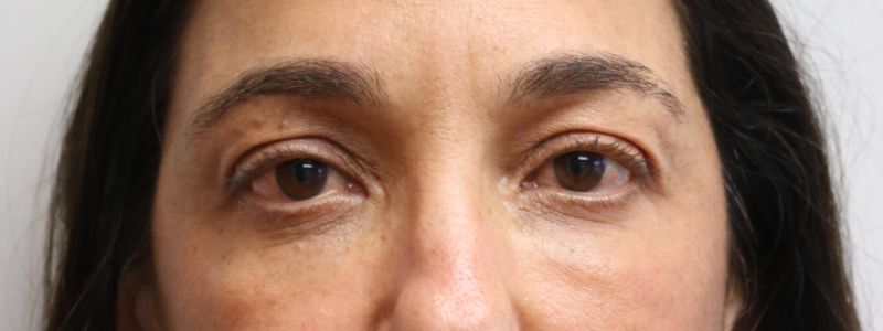 Upper Blepharoplasty Before & After