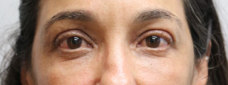 Upper Blepharoplasty Before & After