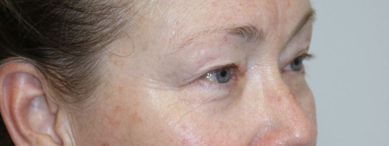 Upper Blepharoplasty Before & After