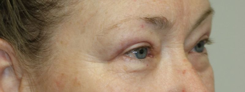 Upper Blepharoplasty Before & After