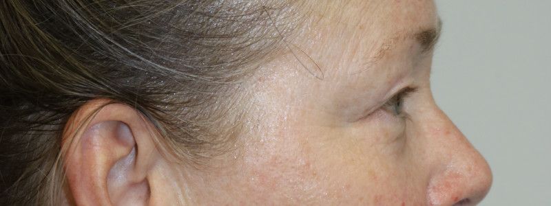 Upper Blepharoplasty Before & After