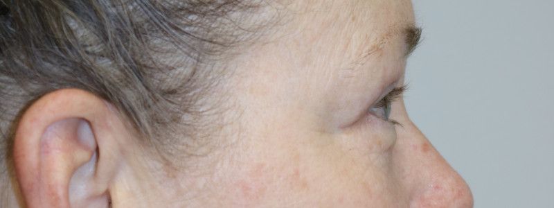 Upper Blepharoplasty Before & After