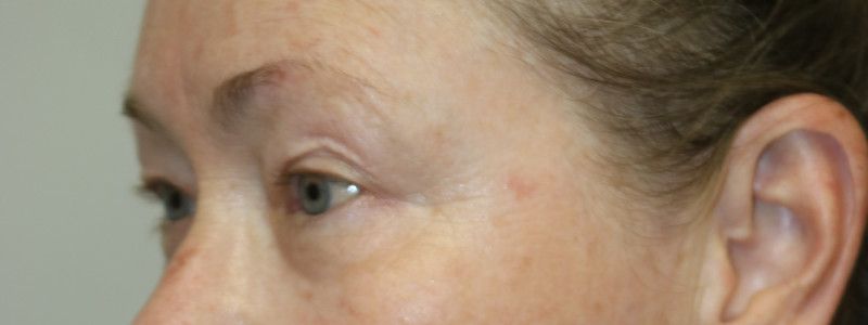 Upper Blepharoplasty Before & After