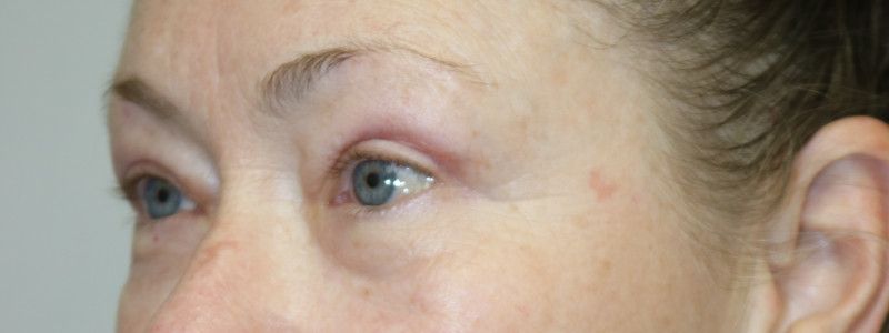 Upper Blepharoplasty Before & After