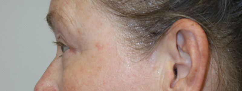 Upper Blepharoplasty Before & After